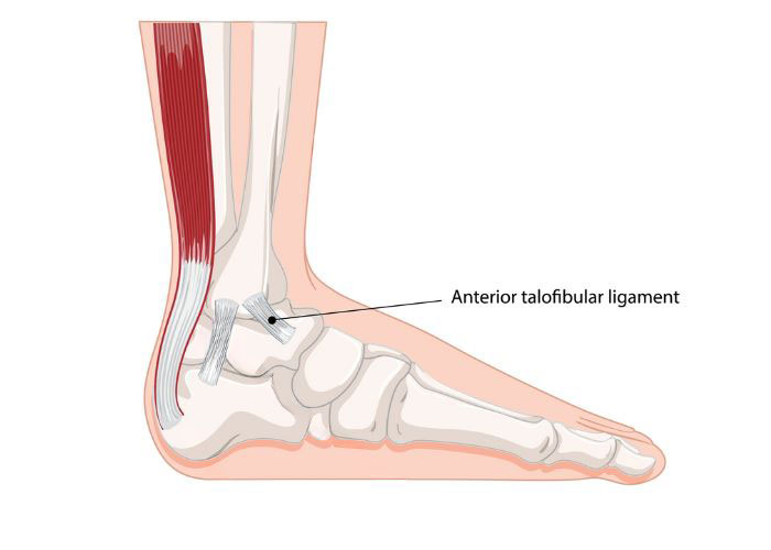 Before ATFL Injury Treatment